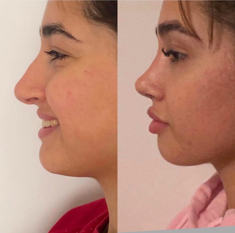 Before and After Result